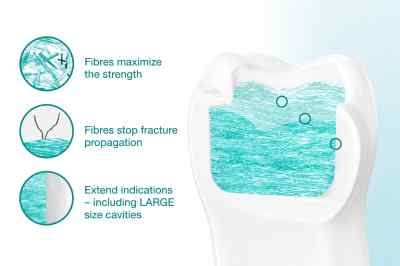 GC Everx Posterior GC Everx Posterior