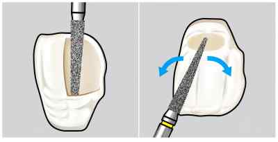 Shofu Direct Cosmetic Restoration Kit
