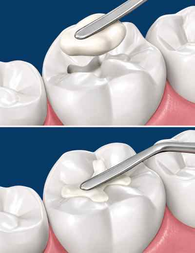 Shofu Beautifil Bulk Restorative Composite Shofu Beautifil Bulk Restorative Composite