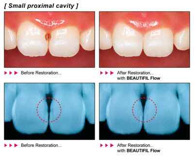 Shofu Beautifil Flow F02 Refill Flowable Composite Shofu Beautifil Flow F02 Refill Flowable Composite