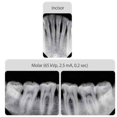 New Vatech EzRay Air Plus Portable Dental X Ray Machine