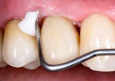 GC Gold Label 1 Luting & Lining Glass Ionomer Cement GC Gold Label 1 Luting & Lining Glass Ionomer Cement